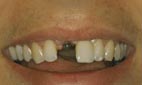 Ablauf einer Zahnimplantation